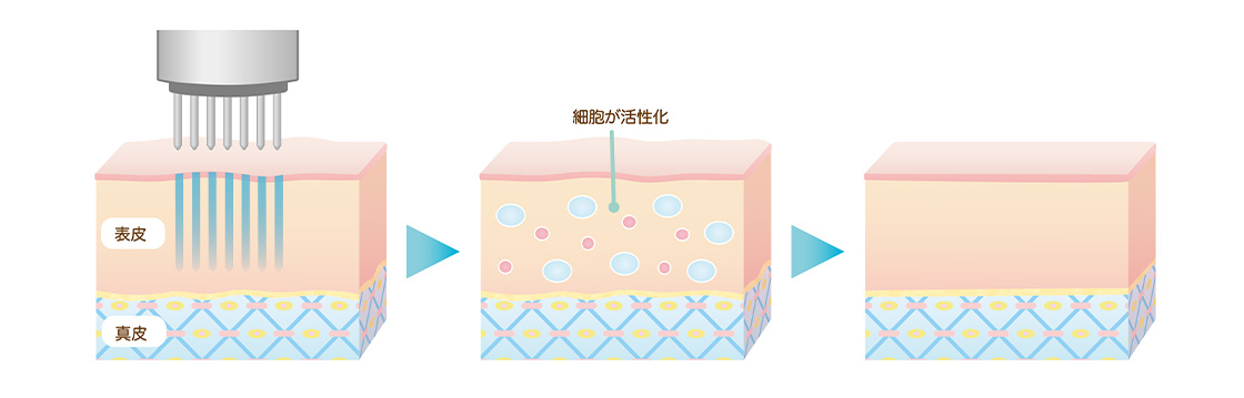 ダーマペン施術